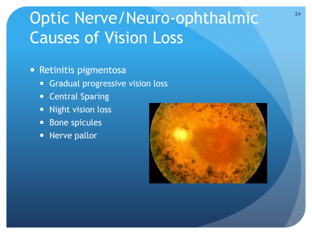 Optic nerve/neuro-ophthalmic causes of vision loss for retinitis pigmentosa
ZEv Shulkin, MD
UT SW Medical Center
. picture of optic nerve